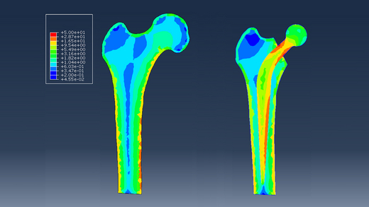 On the left: a computer image of a healthy thigh bone; on the right: a bone with an implant. On both images, certain fragments of the bone are coloured variously, which translates to different stresses influencing the bone.